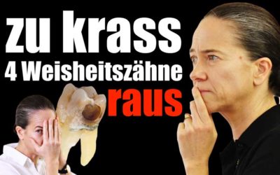 WEISHEITSZÄHNE ENTFERNEN – ALLE AUF EINMAL ODER LIEBER SEPARAT?